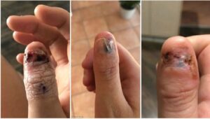 SOCIALES CANCER DE UÑAS