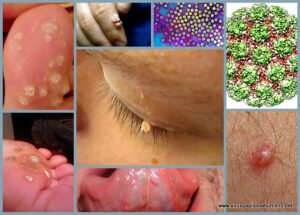 SOCIALES VIRUS DEL PAPILOMA