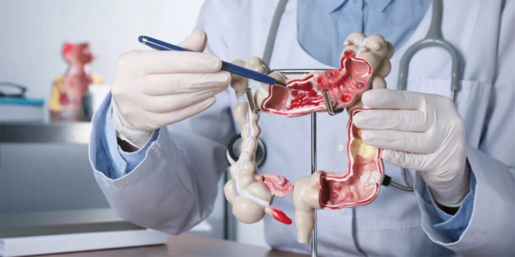 SOCIALES CANCER COLON