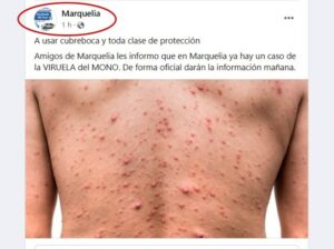Marquelia.-Falso caso viruela del mono