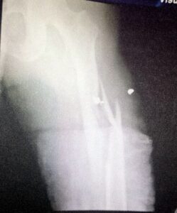 ROJA RADIOGRAFÍA DE FRACTURA DE SU PIERNA