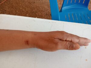 SAN LUIS LESIONES EN MUÑECA E HINCHAZÓN (2)