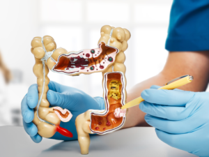 NACIONAL CANCER COLO RECTAL