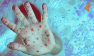 nacional brote de mpox