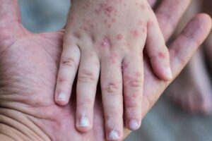 estado Virus Coxsackie (2)